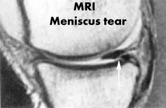 Meniscus-MRI